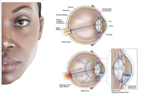 Glaucoma and what to look out for…
