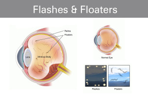What are Flashes & Floaters?